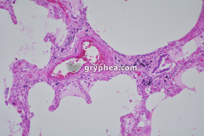 Poumon de fumeur x40 - gryphea.org